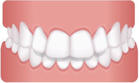 I want to straighten my teeth