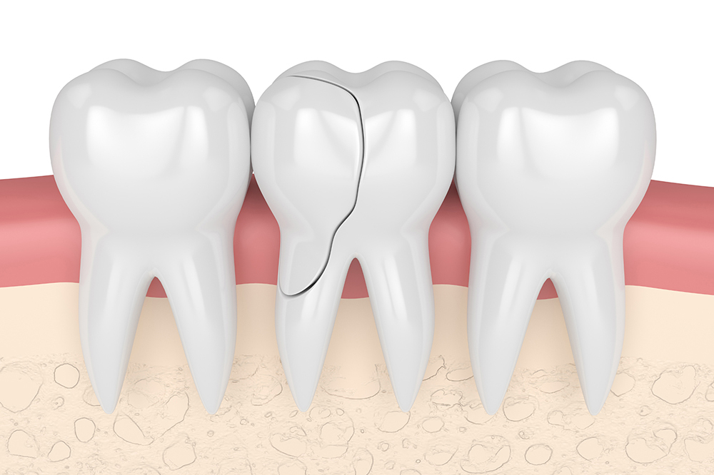 Broken, chipped or missing teeth