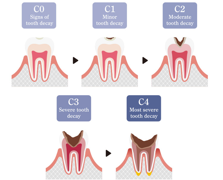 dental caries treatment