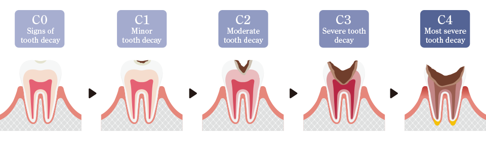 Toothache, sesitive tooth