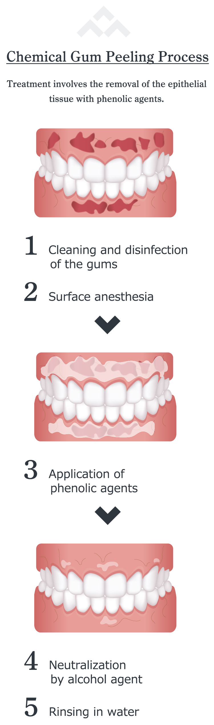 Gums Peeling