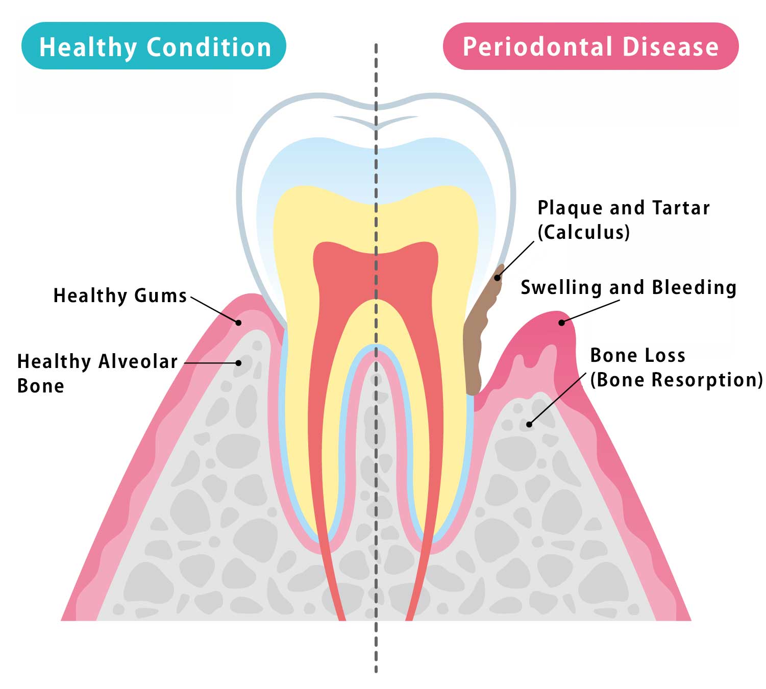 歯周病のイラスト
