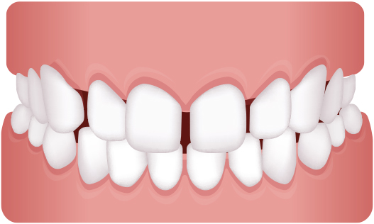 歯並びを治したい