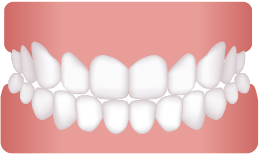 歯並びを治したい