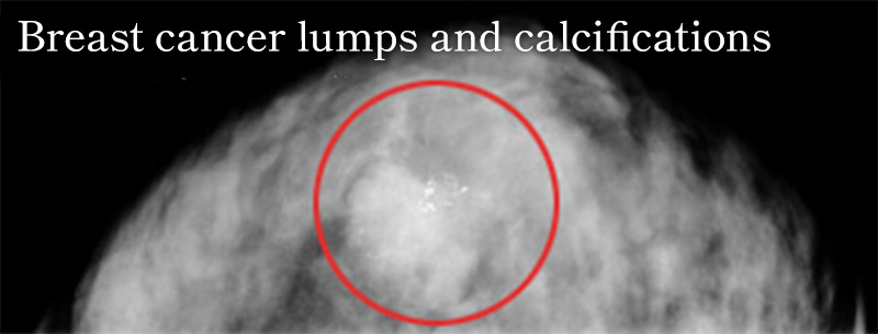 Breast Cancer Lumps and Calcifications